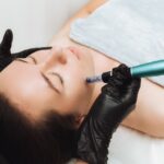 Kvinna som får microneedling